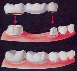 牙齒缺失嘅修復方法都有邊些？