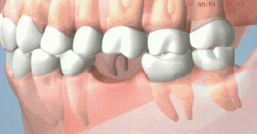 牙齒缺損修復方法推薦
