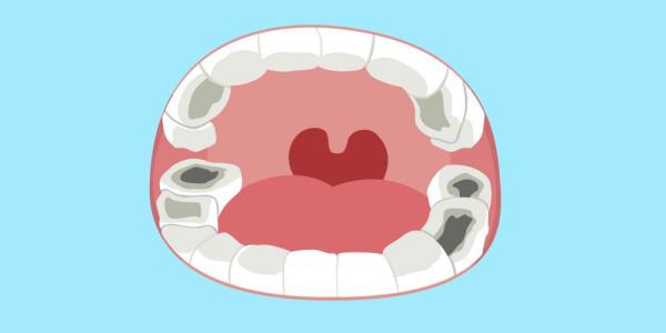 兒童預防蛀牙有邊些方法