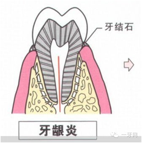 牙齦炎症狀
