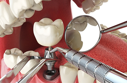 種植牙牙齒修複技術的好處