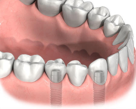 種植牙的修複原理以及適應人群