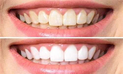 什麽是牙菌斑和牙石？它們是怎麽形成的？