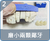 珠海allon4種植牙收費