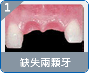 珠海allon4種植牙收費