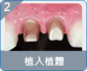 珠海allon4種植牙收費