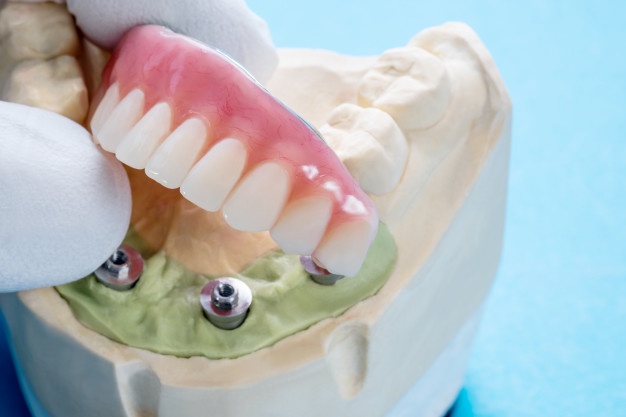dental-implant-use_60829-852