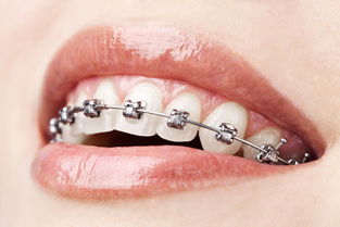 帶牙套會腐蝕牙面嗎？