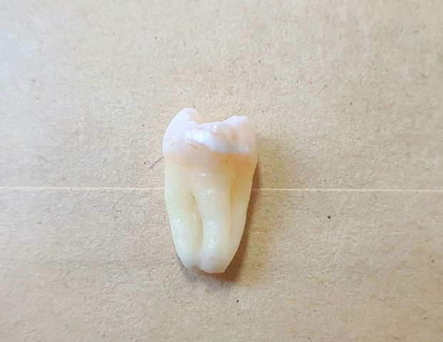 拔智齒痛嗎?我嘅拔智齒經歷