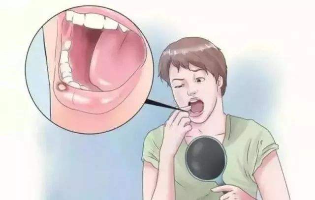 口腔潰瘍嘅治療方法