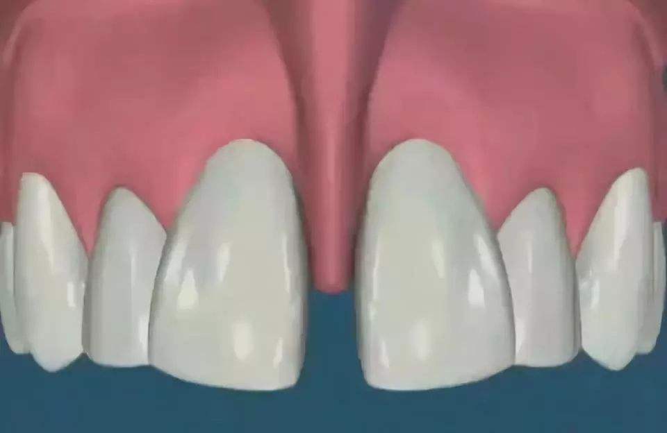 牙齒稀疏嘅修復方法有邊啲？