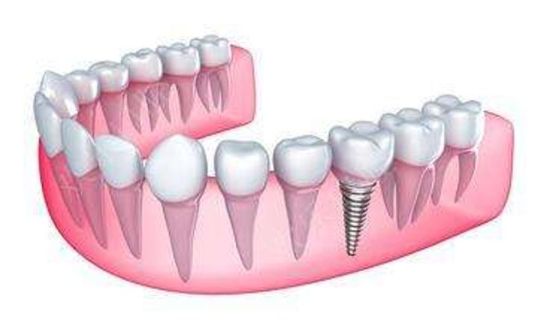 患者必知：種牙術後注意事項