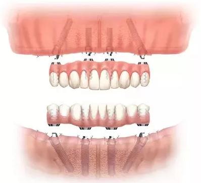 全口植牙嘅注意事項有乜？