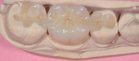 嵌體補牙嘅優勢和適應症有邊啲？