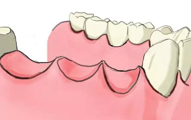 牙齒缺失會有乜隱患？