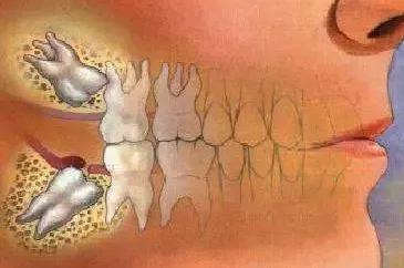 阻生牙嘅危害有乜？