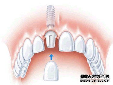 種植牙系乜?