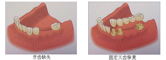 牙齒缺失後點辦？