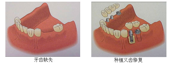 牙齒缺失後點辦？