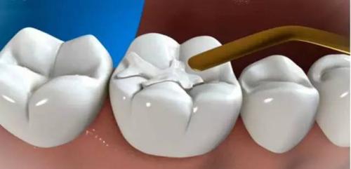 補牙流程