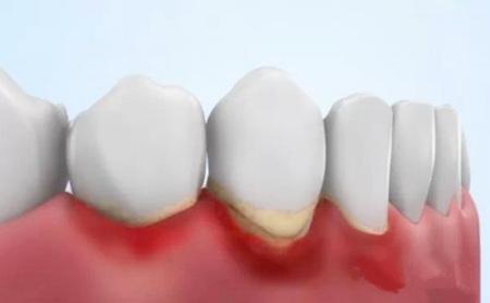 牙周疾病有邊些類型