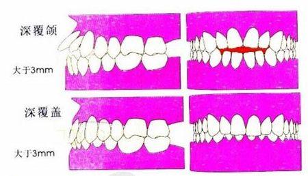 牙齒深覆合系咩回事？