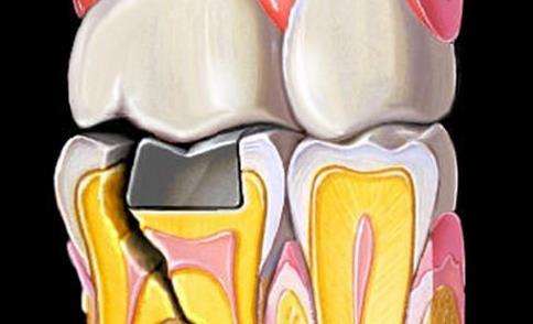 牙隱裂是什麼