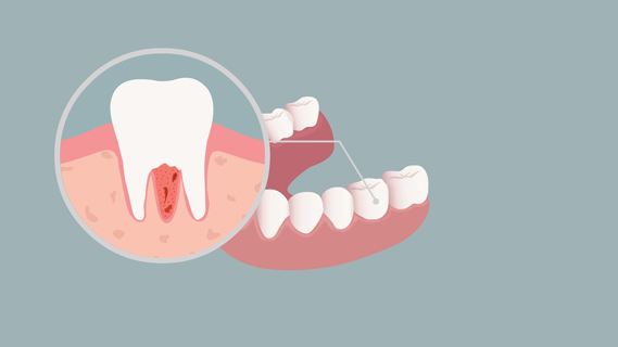 澳门牙周炎治療要多少錢