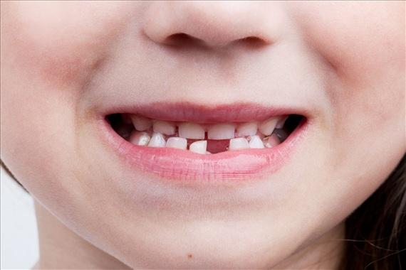 兒童箍牙牙套有什麼風險