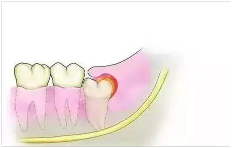 如何避免智齒發炎