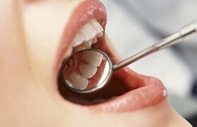 洗牙可以去除牙石嗎