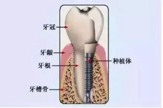 珠海全口種牙過程