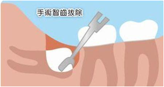 拔智慧牙嘅最佳年齡