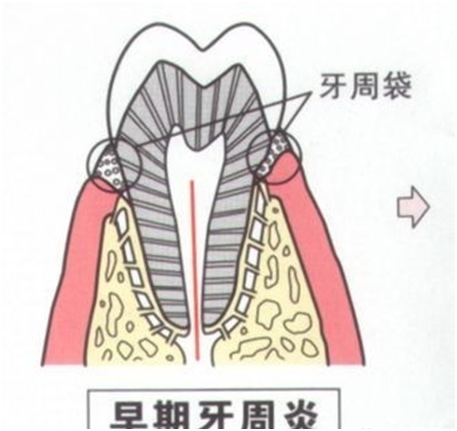 牙齦炎症狀