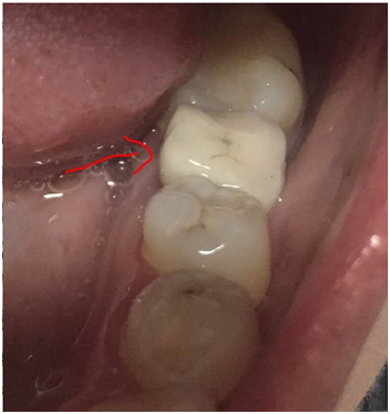 種牙經歷