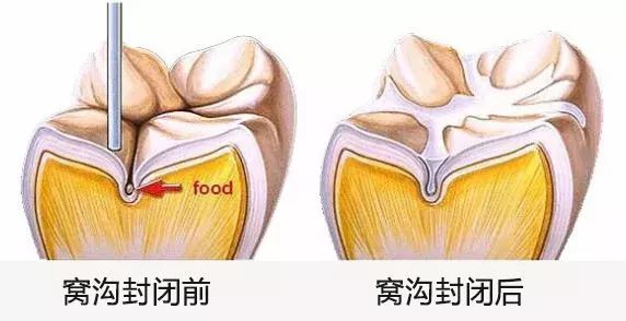 窩溝封閉系乜