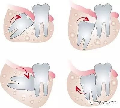 拔智慧齒價錢