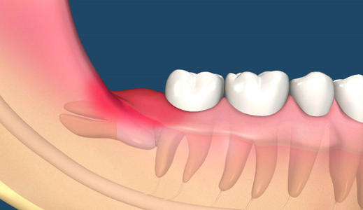 阻生智慧牙嘅危害！有智慧牙D人注意la！