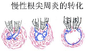 珠海根尖炎治療