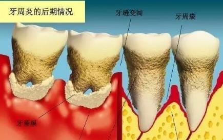 珠海牙周炎