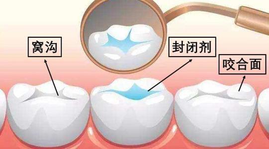 兒童窩溝封閉