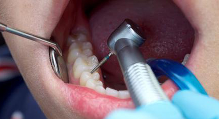  補牙流程有哪些？